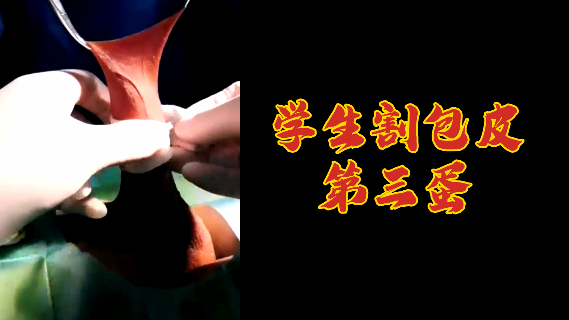 【白嫖一蛋，有血慎看】學生割包皮，第三蛋